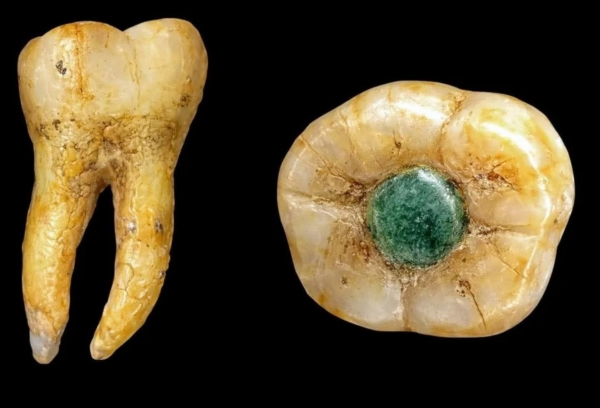 Incrustaciones de jade en los dientes